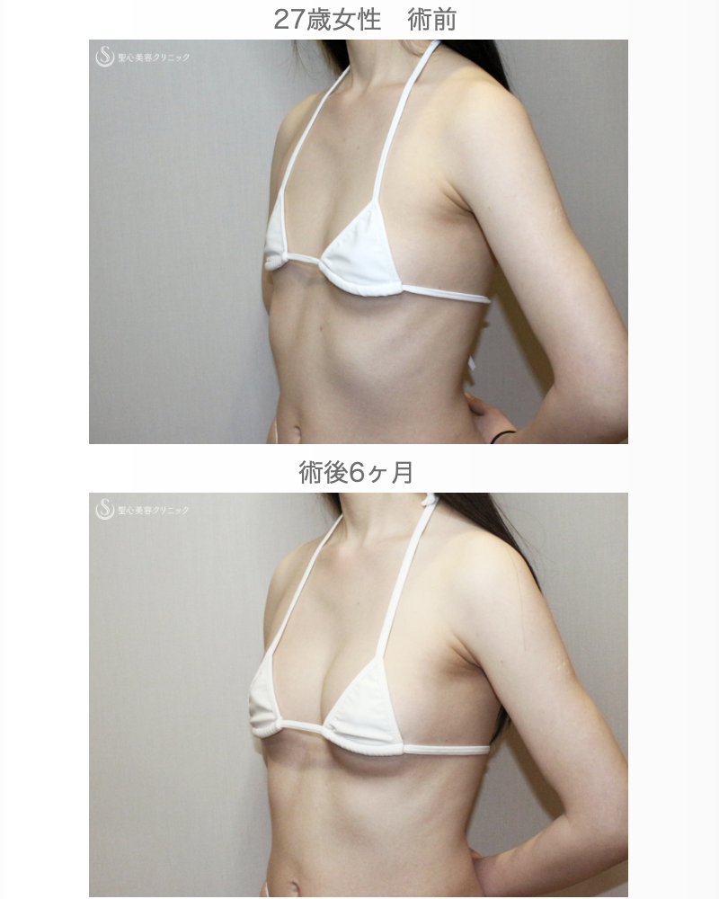 【27歳女性・脂肪幹細胞豊胸】プレミアムセリューション豊胸術（術後2日目〜6ヶ月後） After 
