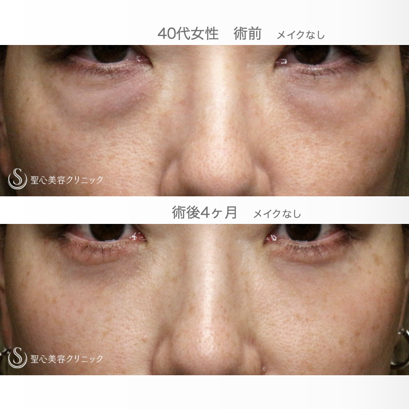 【40代女性・目の下のクマ】表ハムラ+α法「Ver.3」単独例（術直後〜4ヶ月後） After 