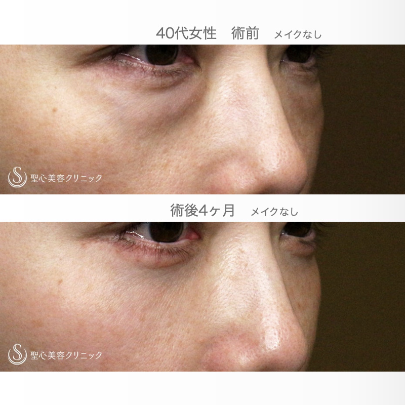 【40代女性・目の下のクマ】表ハムラ+α法「Ver.3」単独例（術直後〜4ヶ月後） After 