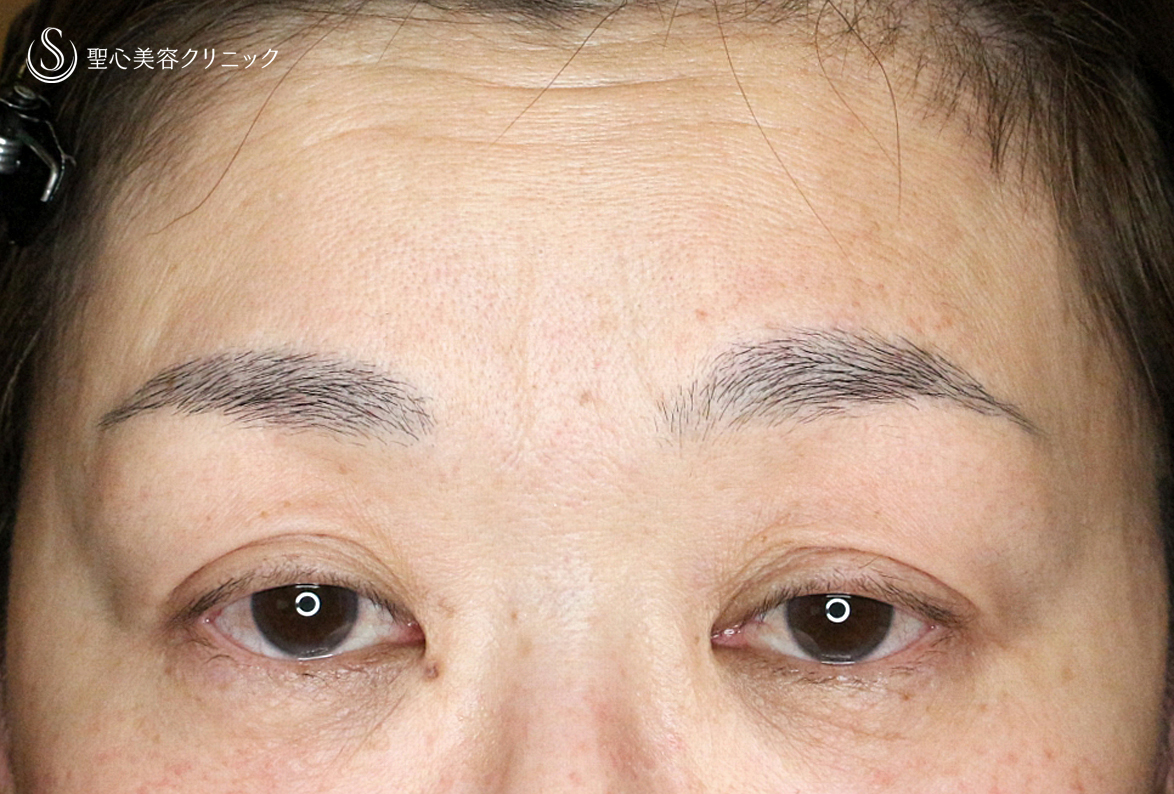 【50代女性・ハードコンタクトレンズ眼瞼下垂】切らない眼瞼下垂+α法（術直後〜1ヶ月後） Before 