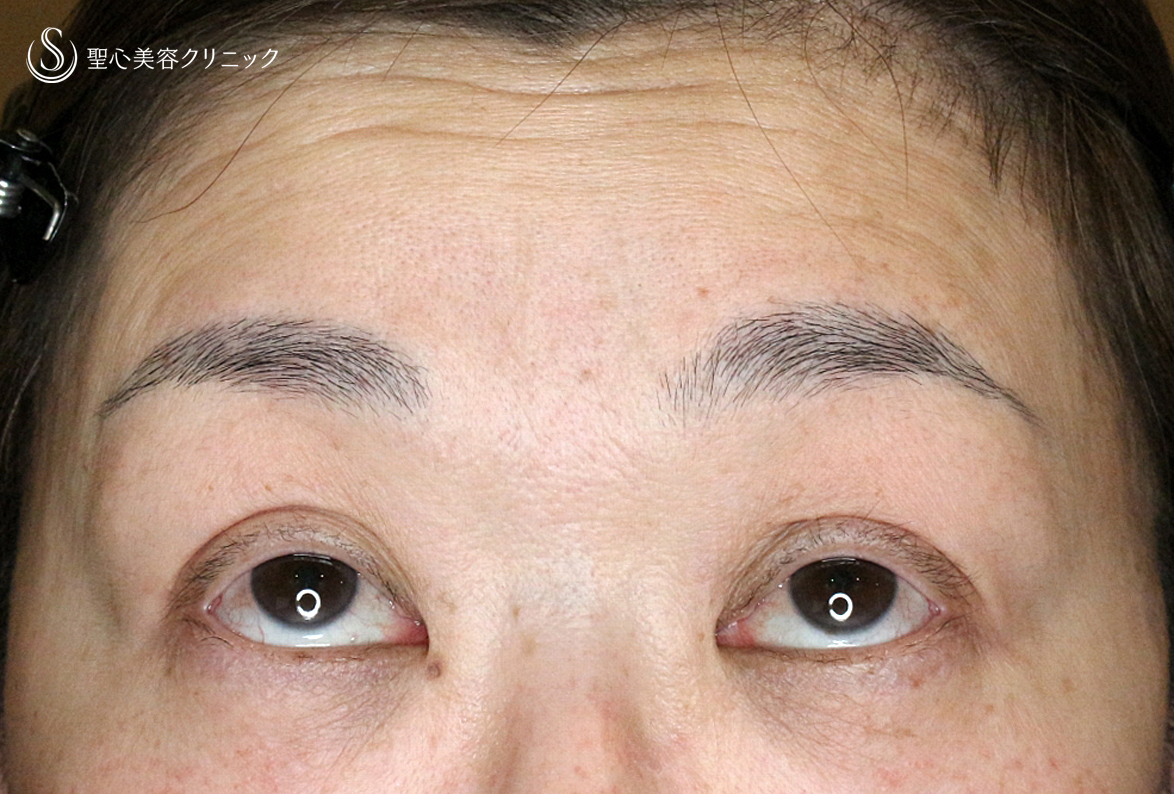 【50代女性・ハードコンタクトレンズ眼瞼下垂】切らない眼瞼下垂+α法（術直後〜1ヶ月後） Before 