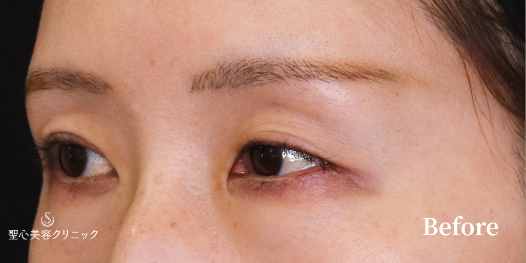 【30代女性・左右のバランスを整える】二重切開法（6ヶ月後） Before 