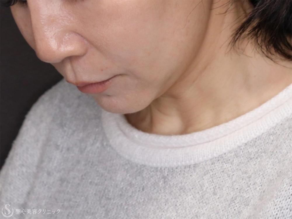 【50女性・首のたるみ】拡大ネックリフト（口元～フェイスライン～首）＋ 脂肪吸引注射（1ヶ月後） After 