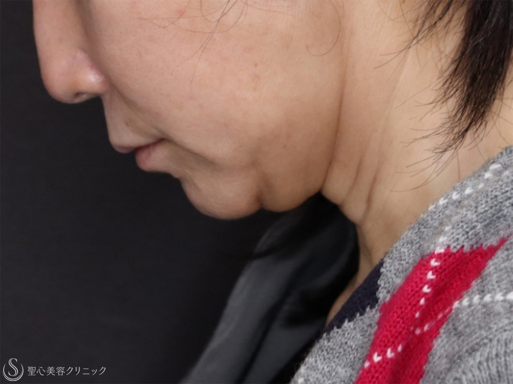 【50女性・首のたるみ】拡大ネックリフト（口元～フェイスライン～首）＋ 脂肪吸引注射（1ヶ月後） Before 