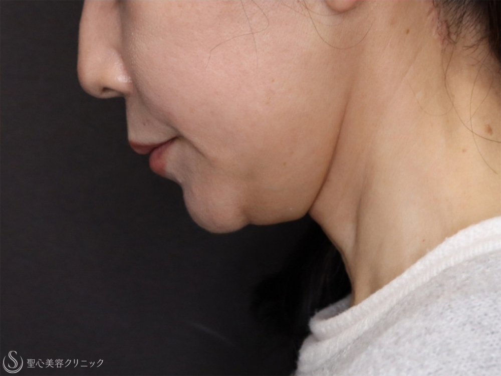 【50女性・首のたるみ】拡大ネックリフト（口元～フェイスライン～首）＋ 脂肪吸引注射（1ヶ月後） After 
