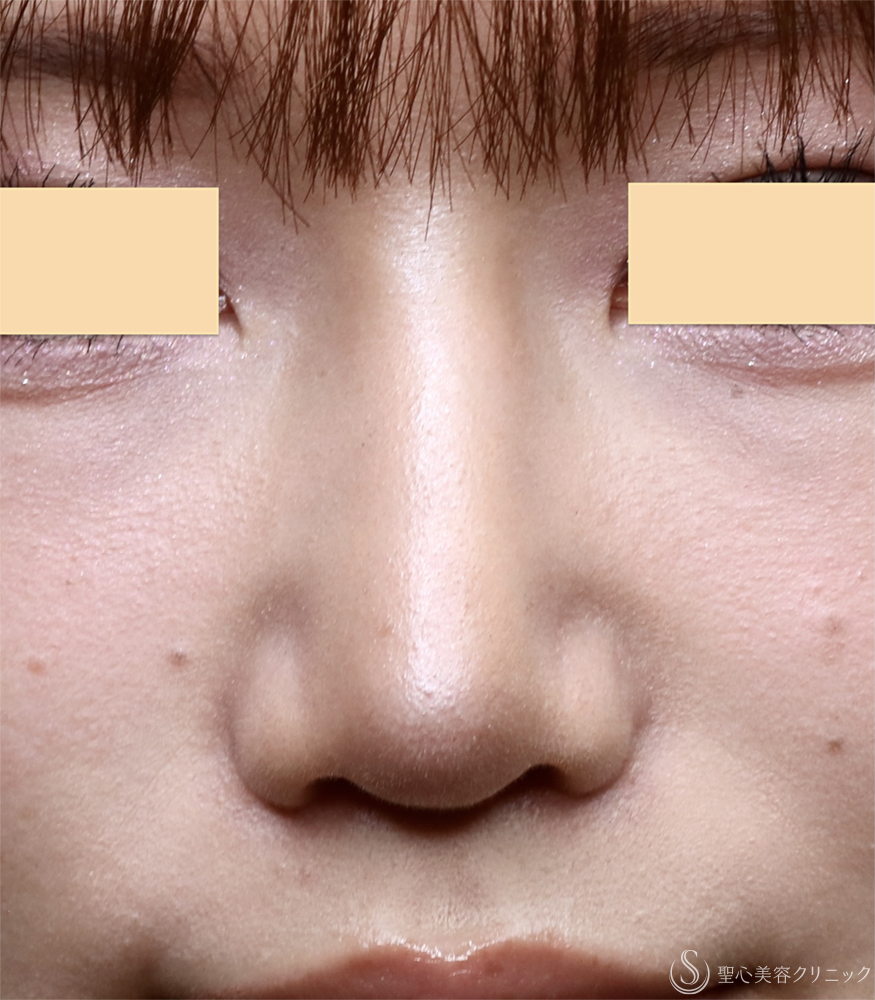 【20代女性・バランスを整える鼻形成】鼻プロテーゼ＋鼻尖形成＋小鼻縮小（1ヶ月後） After 
