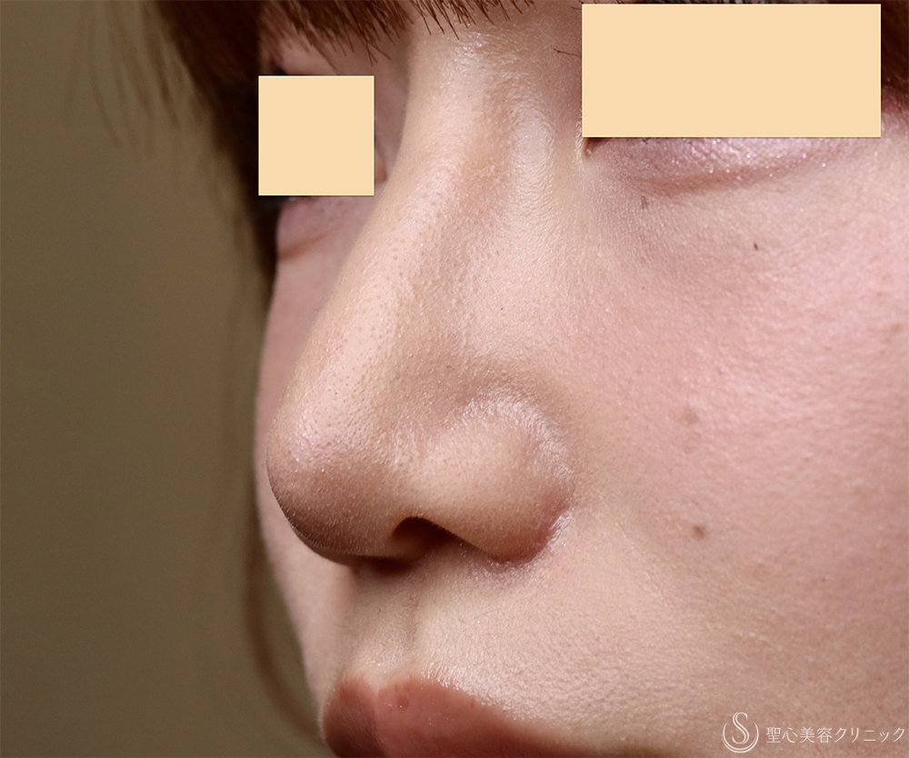 【20代女性・バランスを整える鼻形成】鼻プロテーゼ＋鼻尖形成＋小鼻縮小（1ヶ月後） After 