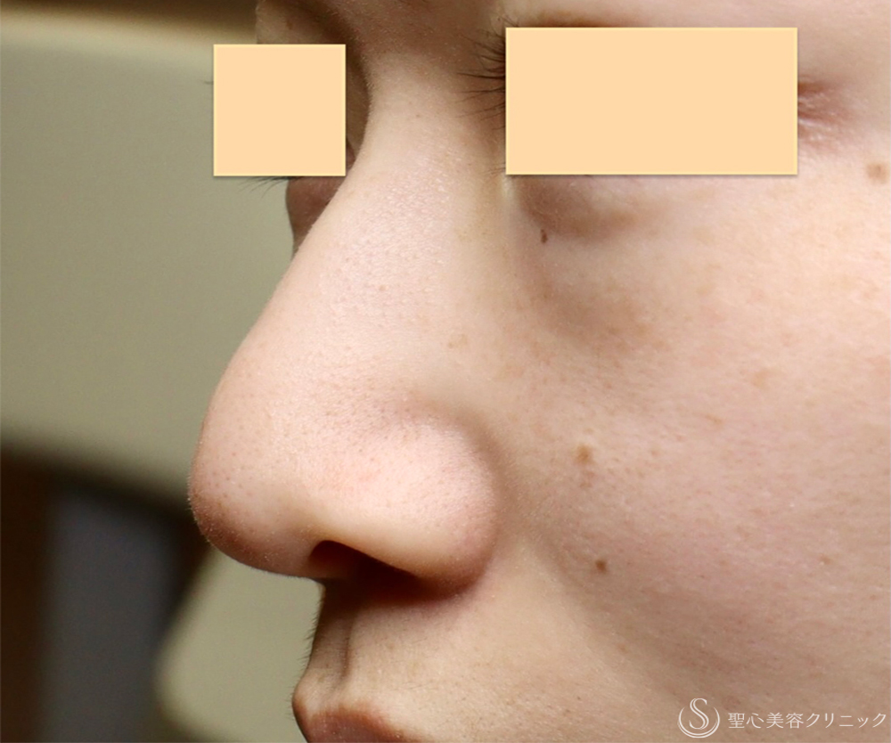 【20代女性・バランスを整える鼻形成】鼻プロテーゼ＋鼻尖形成＋小鼻縮小（1ヶ月後） Before 