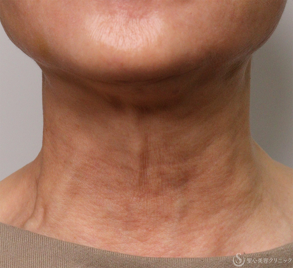 【60代女性・首のちりめんじわ】プルリアル デンシファイ（3回処置・1ヶ月後） Before 