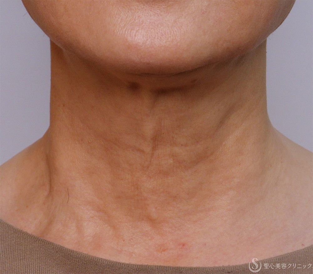 【60代女性・首のちりめんじわ】プルリアル デンシファイ（3回処置・1ヶ月後） After 