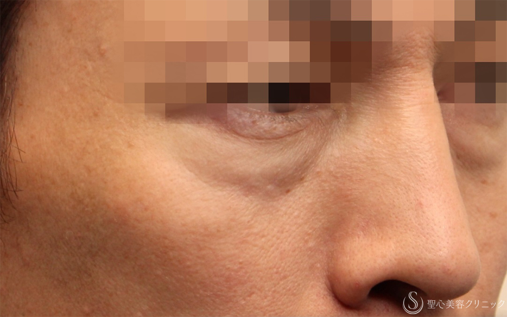 【40代男性・切らないクマ取り】 目の下の脂肪取り（経結膜下脱脂法）（1ヶ月後） Before 