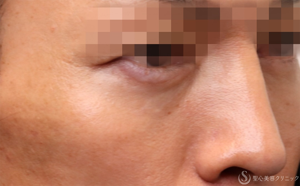 【40代男性・切らないクマ取り】 目の下の脂肪取り（経結膜下脱脂法）（1ヶ月後） After 