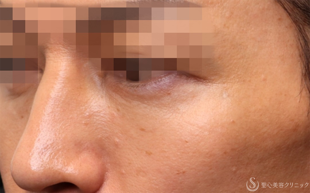 【40代男性・切らないクマ取り】 目の下の脂肪取り（経結膜下脱脂法）（1ヶ月後） After 