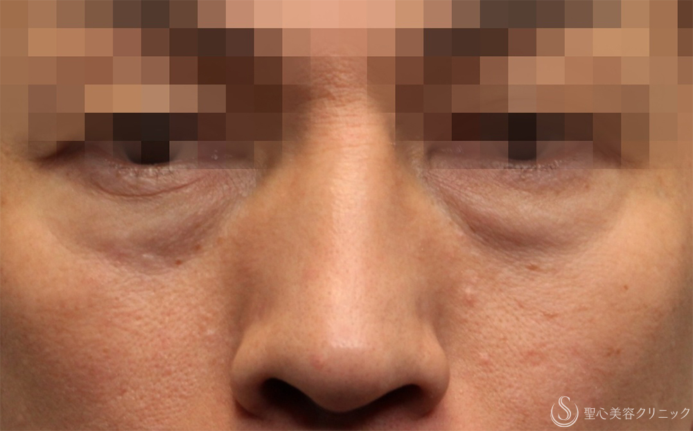 【40代男性・切らないクマ取り】 目の下の脂肪取り（経結膜下脱脂法）（1ヶ月後） Before 