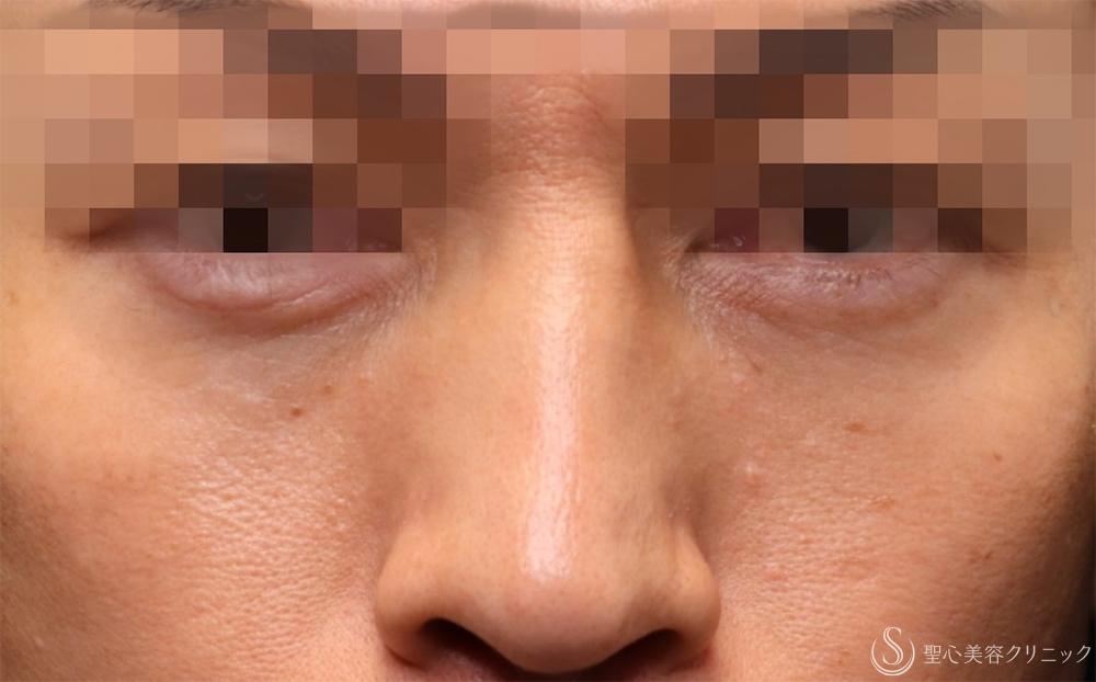 【40代男性・切らないクマ取り】 目の下の脂肪取り（経結膜下脱脂法）（1ヶ月後） After 