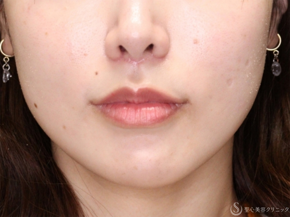 【30代女性・口元付近を自然に整える】小鼻縮小+リップリフト＋プレミアム口角挙上術（1ヶ月後） After 