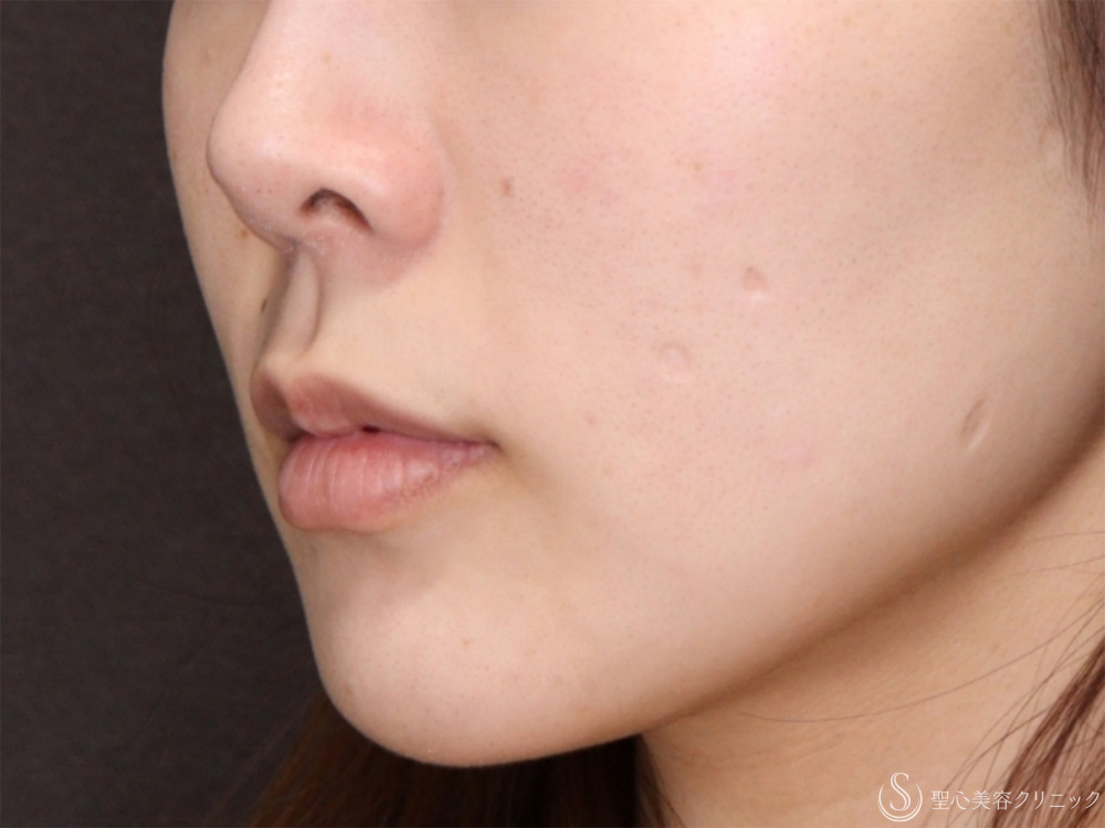 【30代女性・口元付近を自然に整える】小鼻縮小+リップリフト＋プレミアム口角挙上術（1ヶ月後） Before 