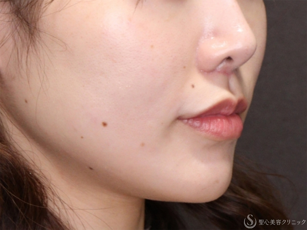 【30代女性・口元付近を自然に整える】小鼻縮小+リップリフト＋プレミアム口角挙上術（1ヶ月後） After 
