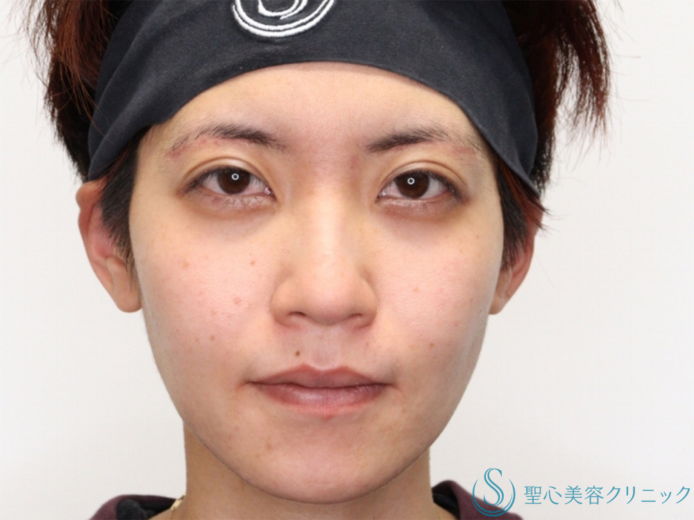 【20代女性・メイク映えのする目に】眉下切開（3ヶ月後） After 