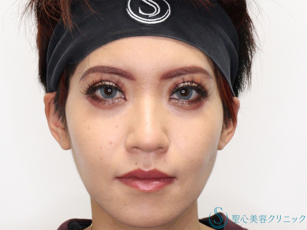 【20代女性・メイク映えのする目に】眉下切開（3ヶ月後） After 