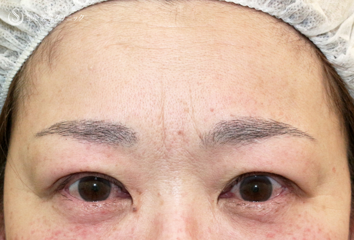 【50代女性・ハードコンタクトレンズ眼瞼下垂】切らない眼瞼下垂+α法（術直後〜1ヶ月後） Before 