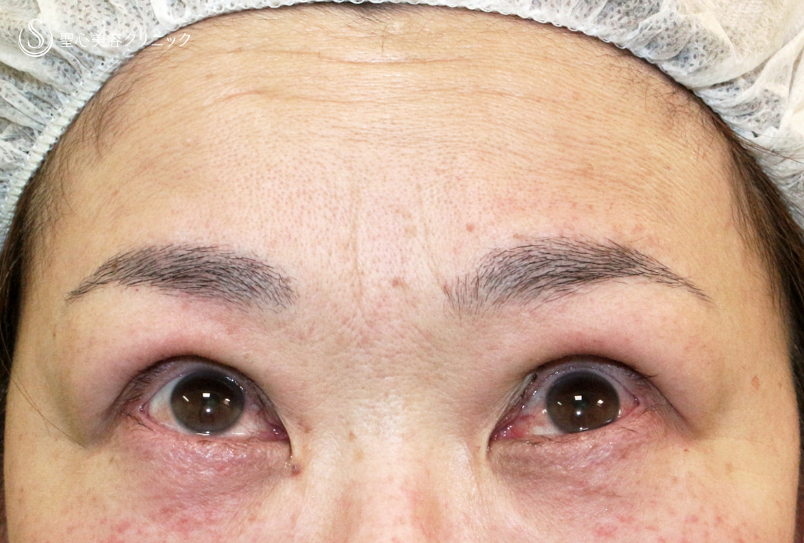 【50代女性・ハードコンタクトレンズ眼瞼下垂】切らない眼瞼下垂+α法（術直後〜1ヶ月後） Before 