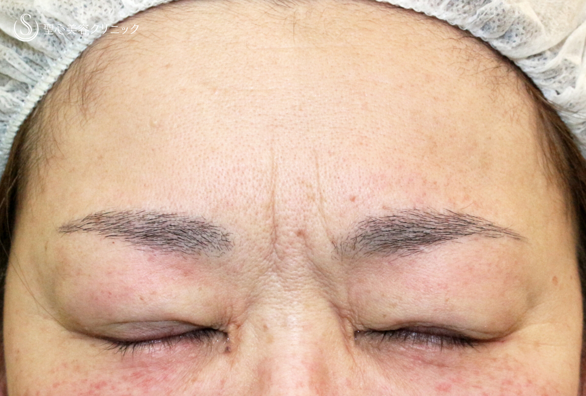 【50代女性・ハードコンタクトレンズ眼瞼下垂】切らない眼瞼下垂+α法（術直後〜1ヶ月後） Before 