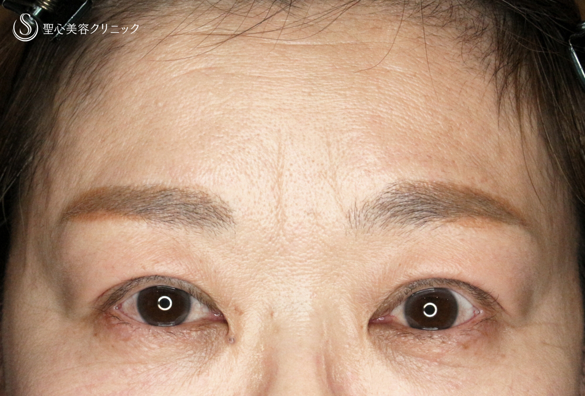 【50代女性・ハードコンタクトレンズ眼瞼下垂】切らない眼瞼下垂+α法（術直後〜1ヶ月後） After 
