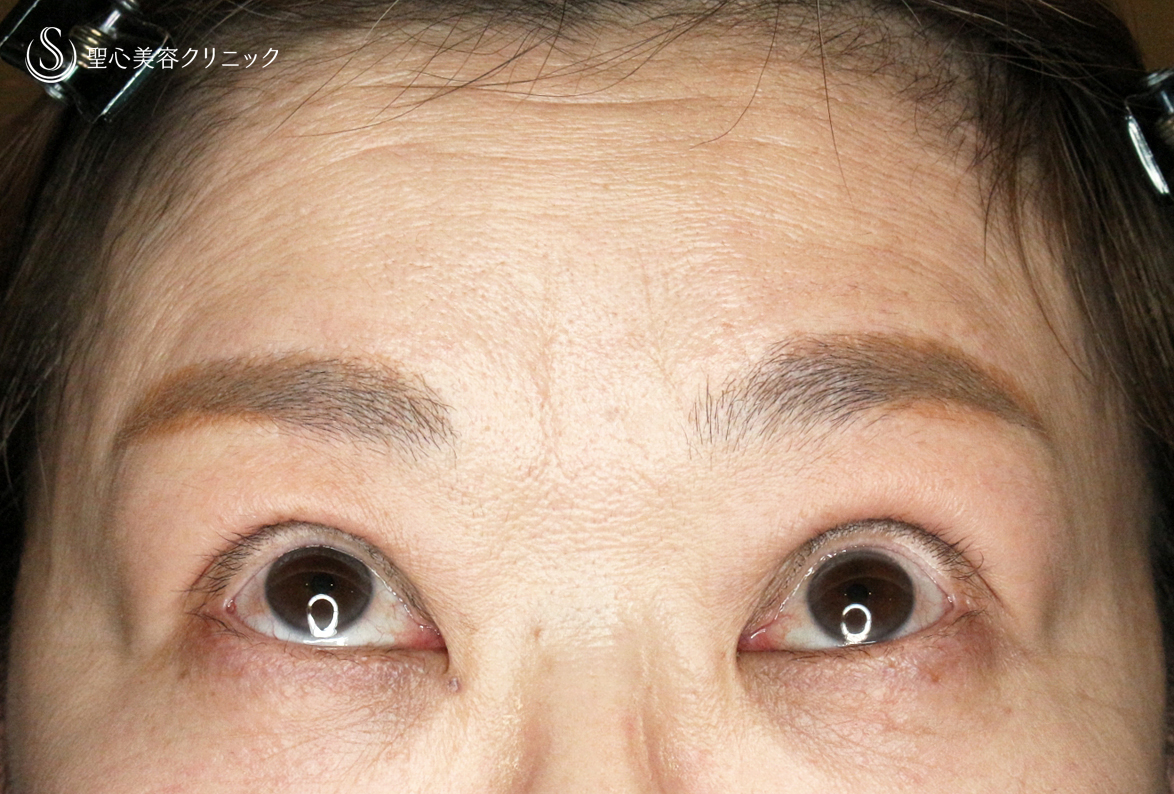 【50代女性・ハードコンタクトレンズ眼瞼下垂】切らない眼瞼下垂+α法（術直後〜1ヶ月後） After 