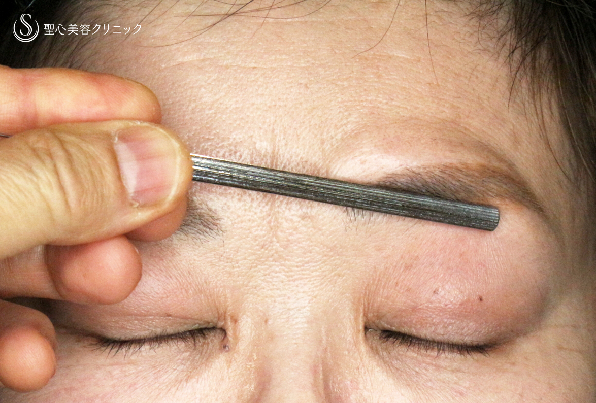 【50代女性・ハードコンタクトレンズ眼瞼下垂】切らない眼瞼下垂+α法（術直後〜1ヶ月後） After 