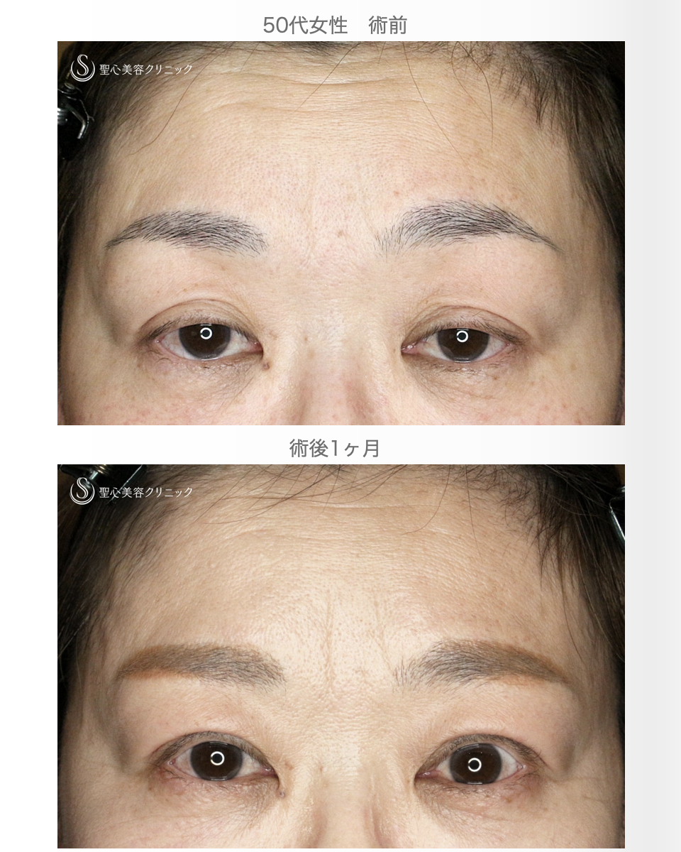 【50代女性・ハードコンタクトレンズ眼瞼下垂】切らない眼瞼下垂+α法（術直後〜1ヶ月後） After 