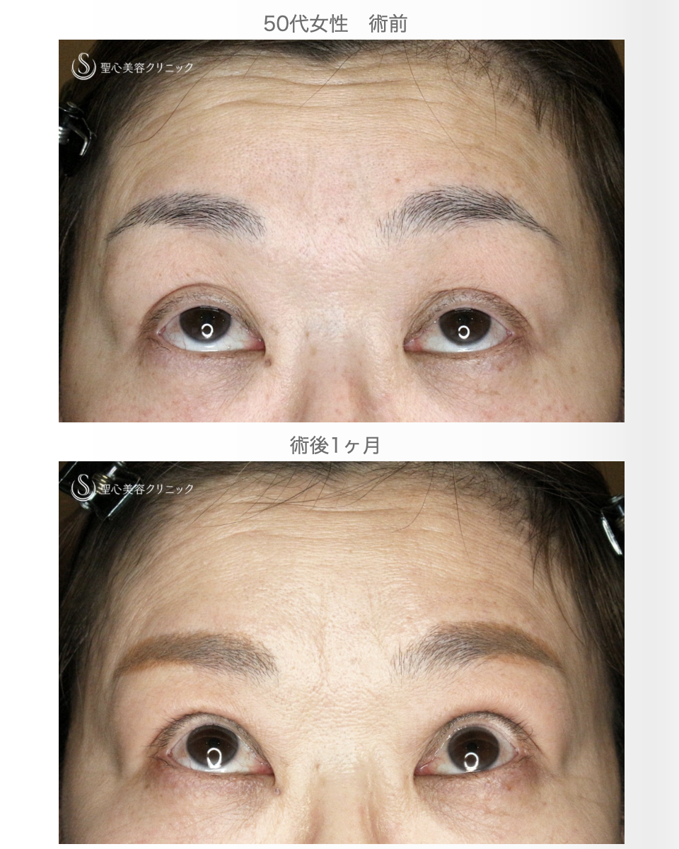 【50代女性・ハードコンタクトレンズ眼瞼下垂】切らない眼瞼下垂+α法（術直後〜1ヶ月後） After 