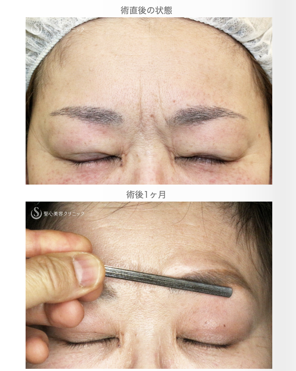 【50代女性・ハードコンタクトレンズ眼瞼下垂】切らない眼瞼下垂+α法（術直後〜1ヶ月後） After 