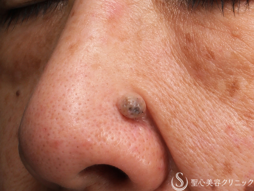 【60代女性・大きなホクロも電気凝固法できれいに】電気凝固法（2ヶ月後） Before 