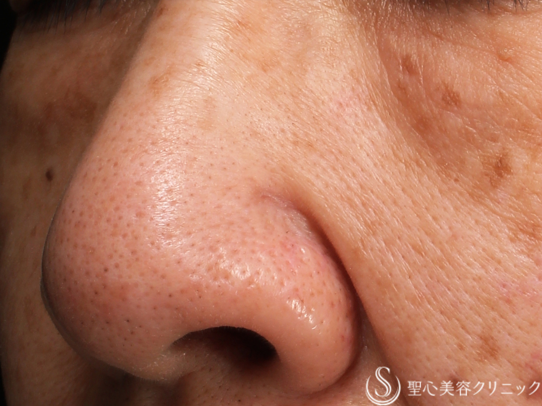 【60代女性・大きなホクロも電気凝固法できれいに】電気凝固法（2ヶ月後） After 