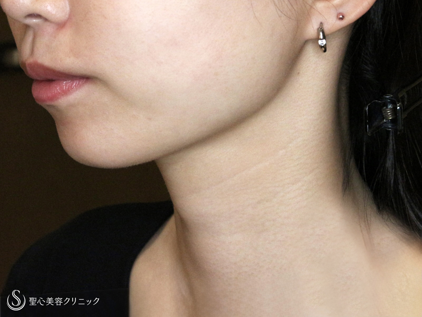 【20台女性・抜群の小顔効果】脂肪吸引注射「あご下」（術直後〜2年後） After 