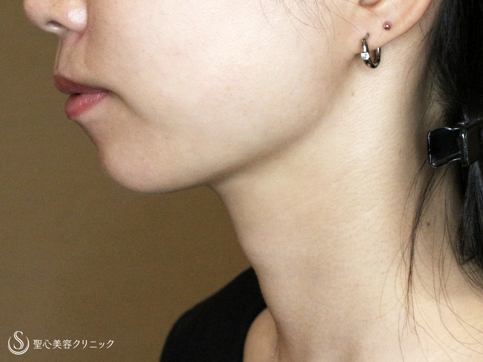 【20台女性・抜群の小顔効果】脂肪吸引注射「あご下」（術直後〜2年後） After 