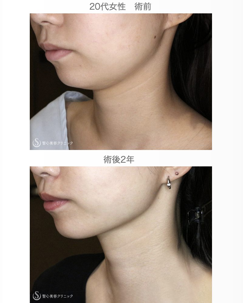 【20台女性・抜群の小顔効果】脂肪吸引注射「あご下」（術直後〜2年後） After 