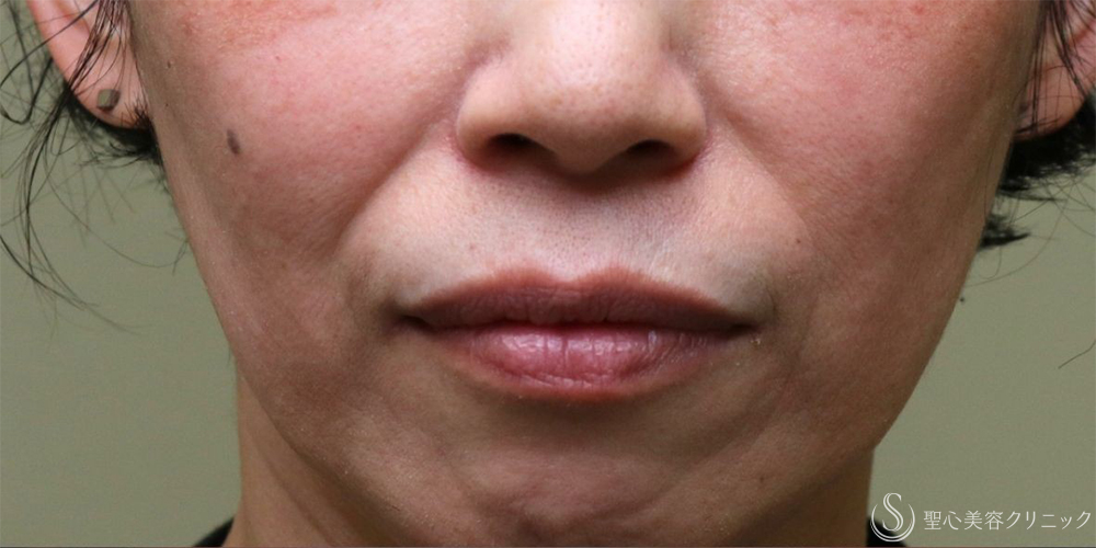 【50代女性・自然な若返り】プレミアムPRP皮膚再生療法（半年後～3年後） Before 名古屋+ヒアルロン酸　法令線　若返り