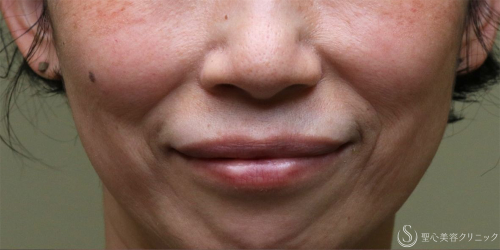 【50代女性・自然な若返り】プレミアムPRP皮膚再生療法（半年後～3年後） Before 名古屋+ヒアルロン酸　法令線　若返り