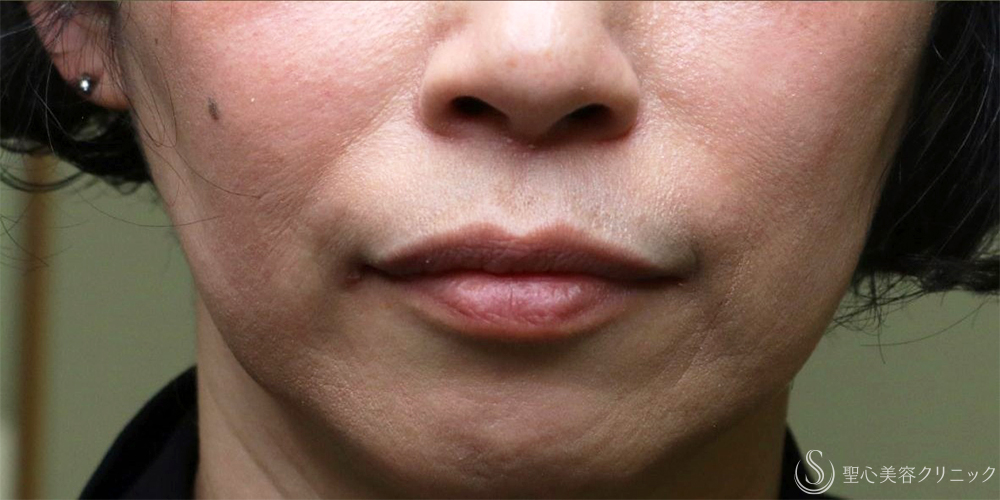 【50代女性・自然な若返り】プレミアムPRP皮膚再生療法（半年後～3年後） After 名古屋+ヒアルロン酸　法令線　若返り