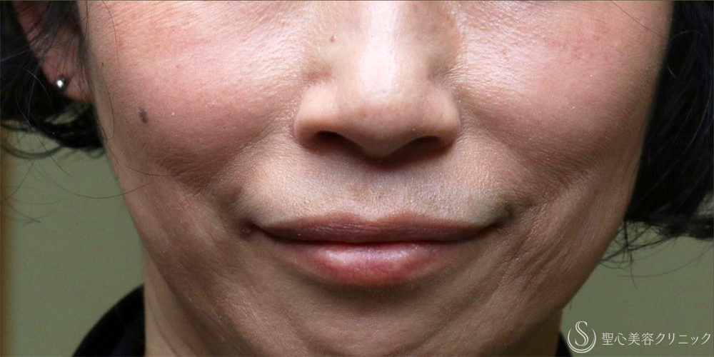 【50代女性・自然な若返り】プレミアムPRP皮膚再生療法（半年後～3年後） After 名古屋+ヒアルロン酸　法令線　若返り