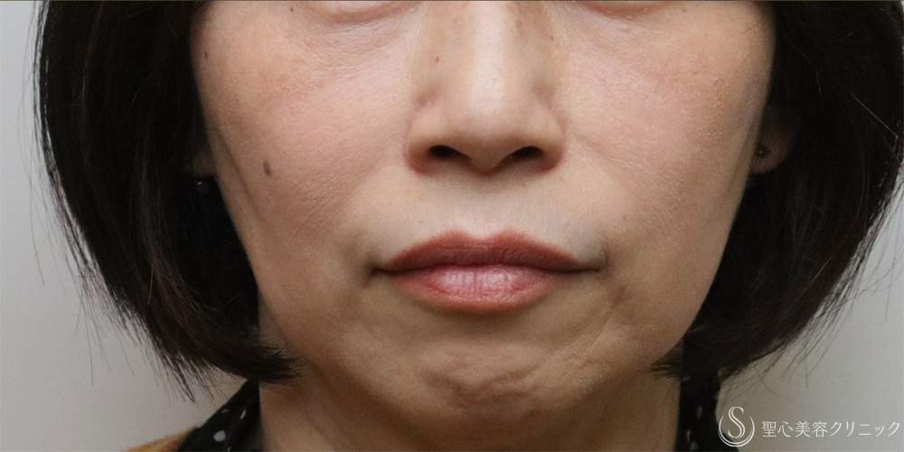 【50代女性・自然な若返り】プレミアムPRP皮膚再生療法（半年後～3年後） After 名古屋+ヒアルロン酸　法令線　若返り