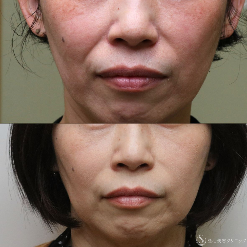 【50代女性・自然な若返り】プレミアムPRP皮膚再生療法（半年後～3年後） After 名古屋+ヒアルロン酸　法令線　若返り