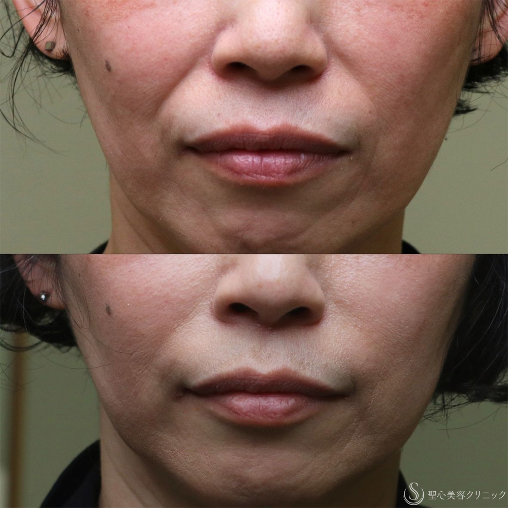 【50代女性・自然な若返り】プレミアムPRP皮膚再生療法（半年後～3年後） After 名古屋+ヒアルロン酸　法令線　若返り