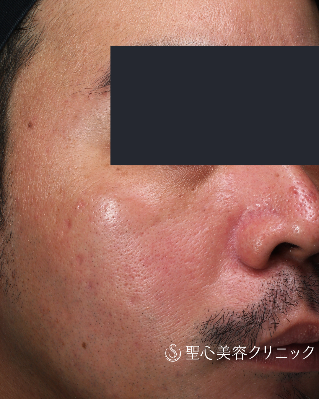 【30代男性・赤みと肌質の改善】ポテンツァ＋マックーム（MacCoom）（1ヶ月後） Before 