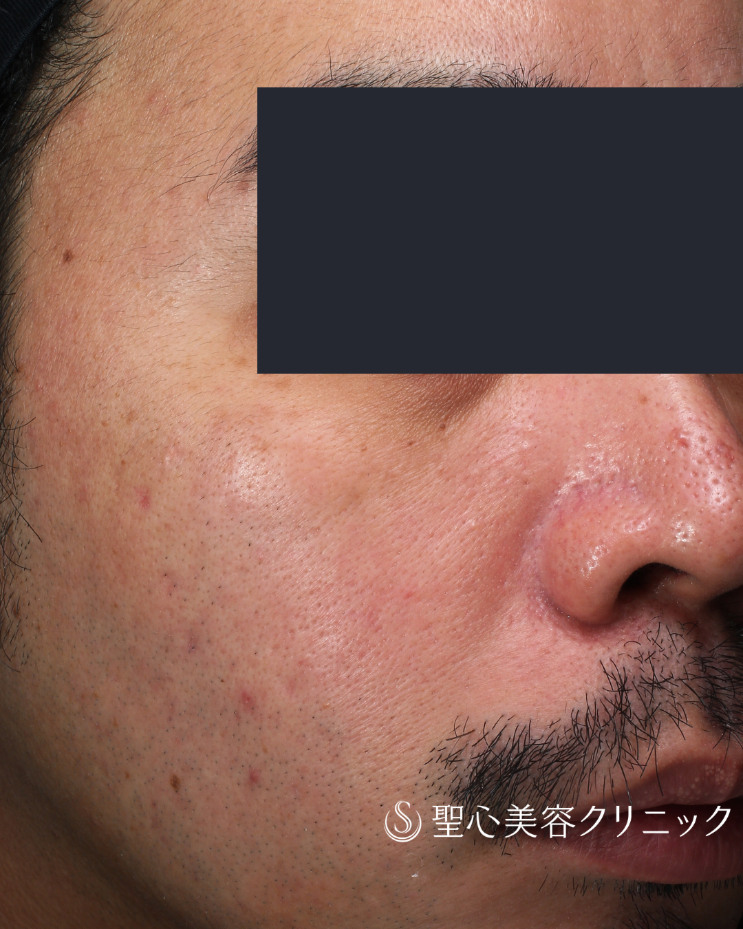 【30代男性・赤みと肌質の改善】ポテンツァ＋マックーム（MacCoom）（1ヶ月後） After 