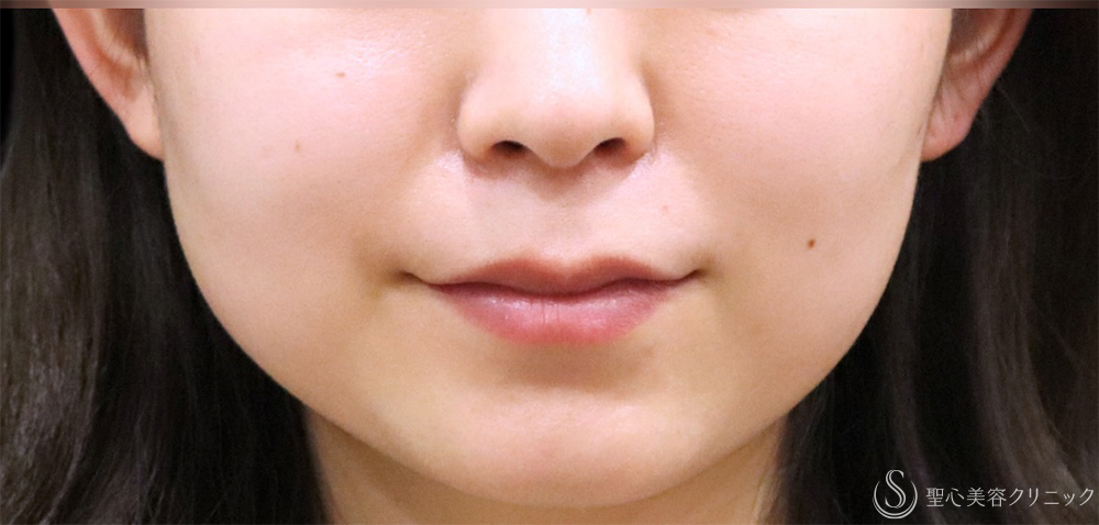 【20代女性・小顔】　ボツリヌストキシン注入（注射）（半年後） Before 
