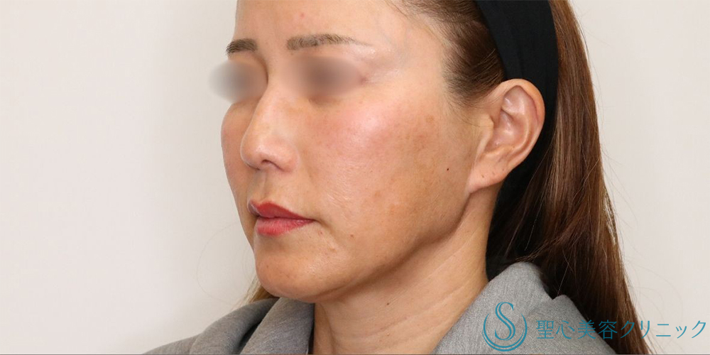 【40代女性・長期的なリフトアップ】フェイスリフト＋脂肪吸引（頬＋顎下）＋リガメント処理（3ヶ月後） Before 名古屋+フェイスリフト　小顔