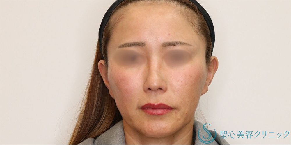 【40代女性・長期的なリフトアップ】フェイスリフト＋脂肪吸引（頬＋顎下）＋リガメント処理（3ヶ月後） Before 名古屋+フェイスリフト　小顔